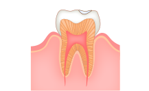 歯の内面の虫歯