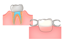 歯の根本だけ残る虫歯